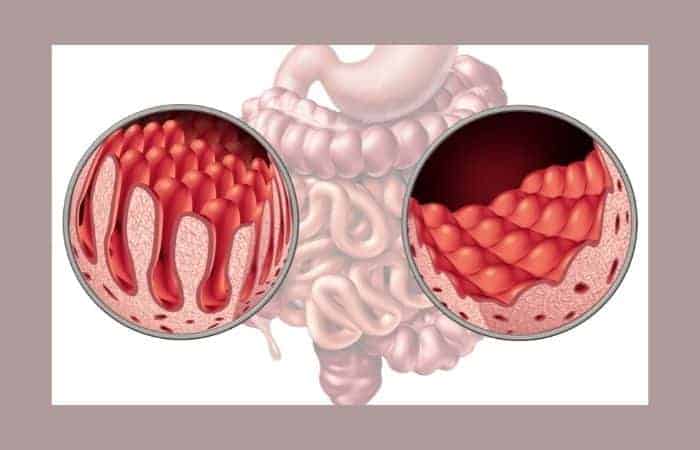 celiac's disease